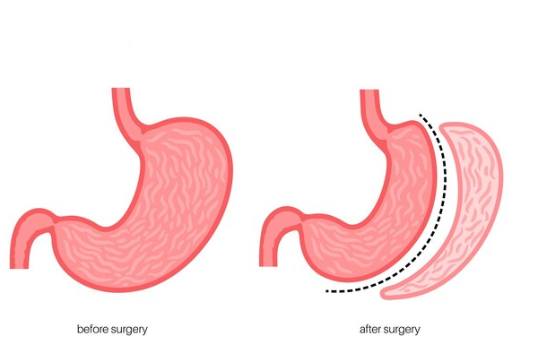 Laparoscopic Sleeve Gastrectomy