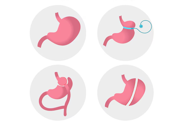 Revision Laparoscopic Bariatric Surgeries