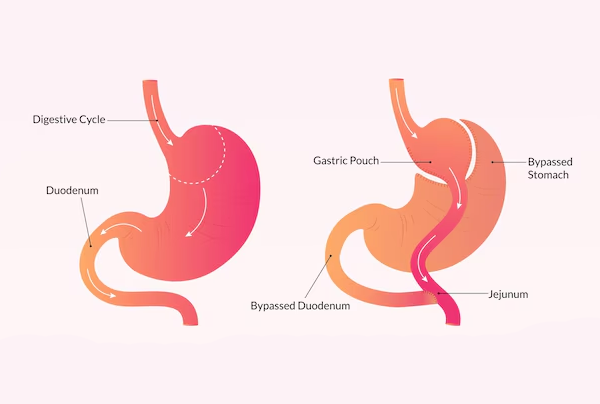 One Anastomosis Gastric By pass