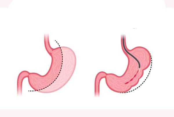 Endoscopic Sleeve Gastroplasty