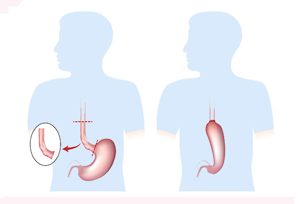 Oesophagectomy