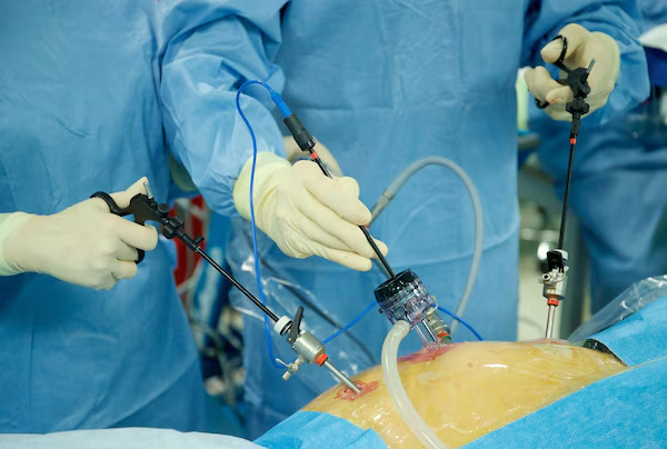 Laparoscopy for Hiatus Hernia