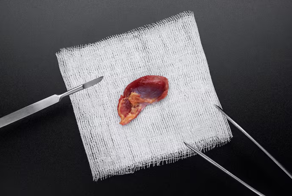 Common Bile Duct Stones