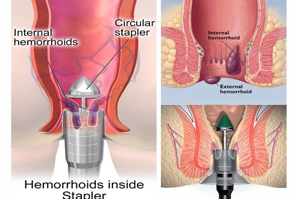 Stapled Transanal Rectal Resection