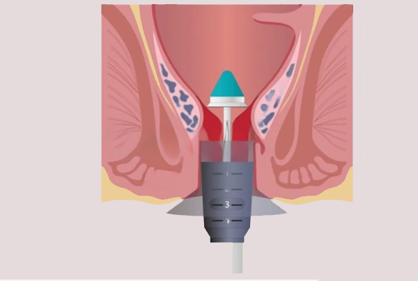 Stapler Haemorrhoidectomy or Laser Hemorrhoidectomy