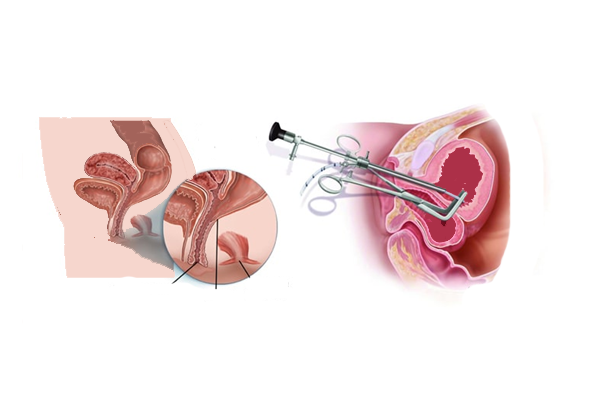Video Assisted Anal Fistula Treatment