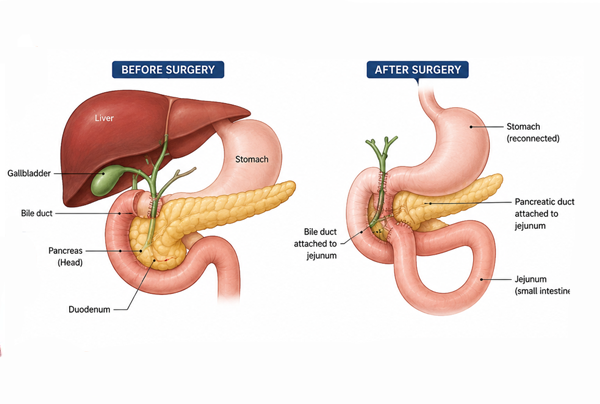 Whipple Procedure Pancreatic Cancer