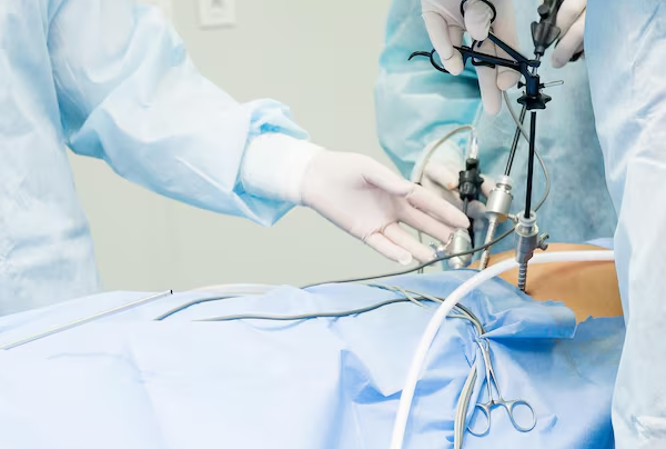 Laparoscopic For Splenectomy