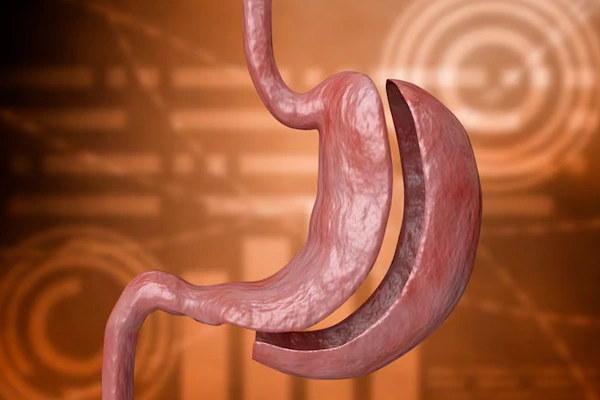 Partial Gastrectomy