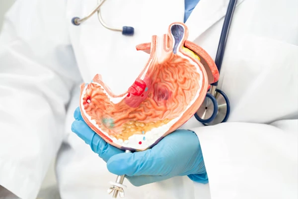 Total Gastrectomy