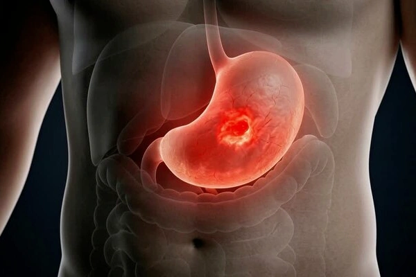 Right Hemicolectomy