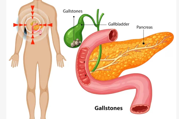 Radical Cholecystectomy