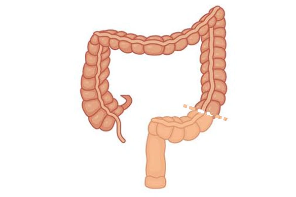 Abdominoperineal Resection