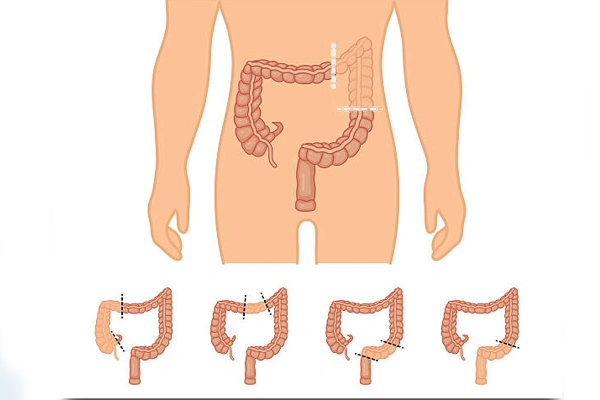 Colorectal Surgery