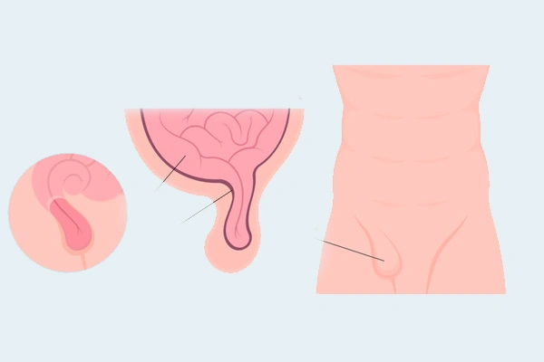 Inguinal