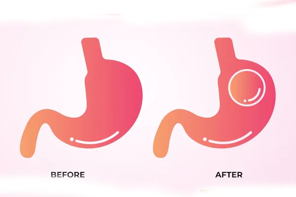 Gastric Balloon