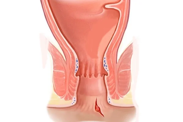 Laser Fissurectomy